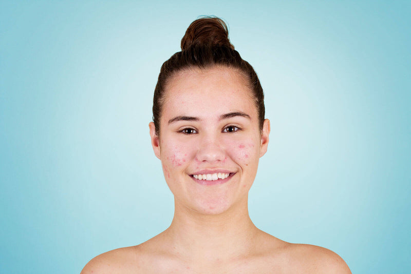 Unclear Kin On Face How you fight pimples - AND get a nice, beautiful and acne free skin!